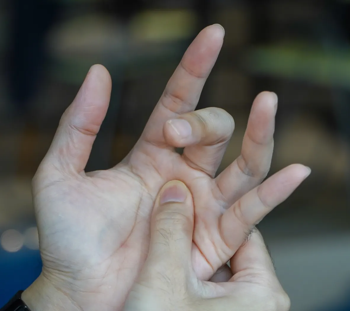 trigger finger release edinburgh