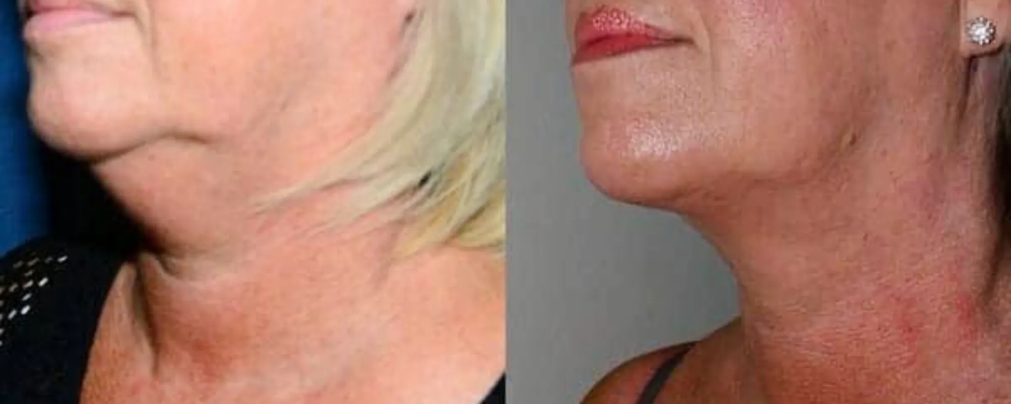 neck liposuction