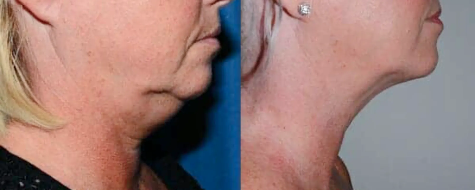 neck liposuction