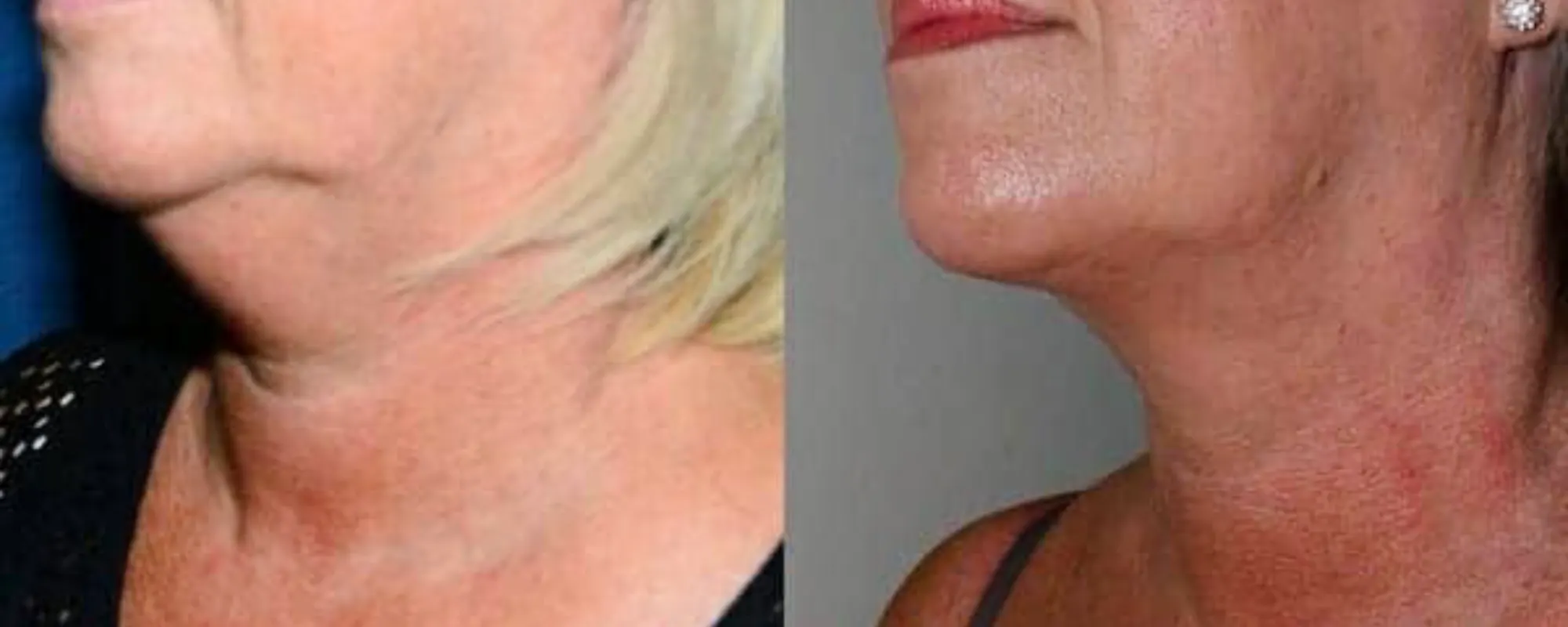 neck liposuction