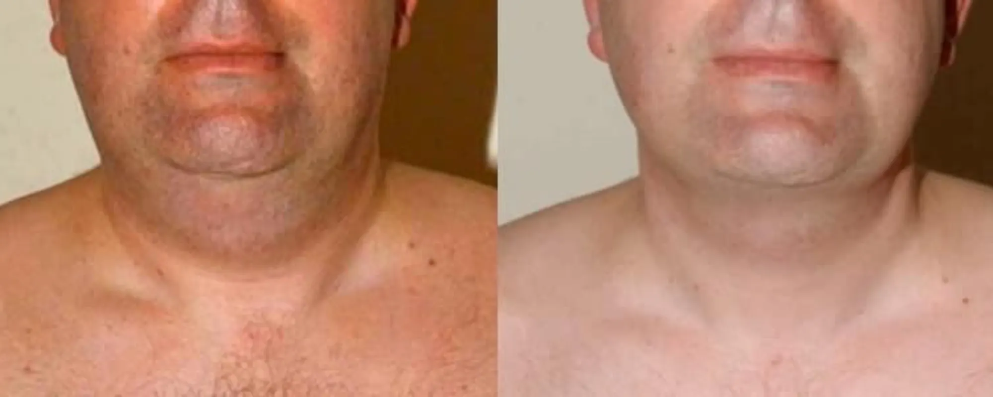 neck liposuction