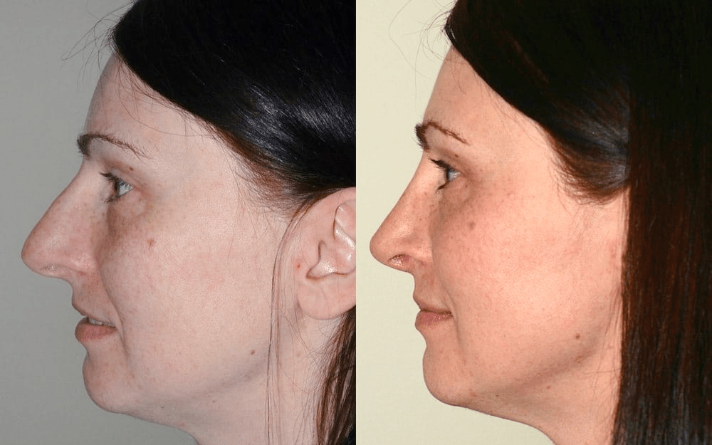 rhinoplasty