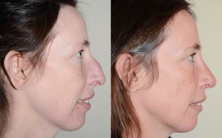 rhinoplasty