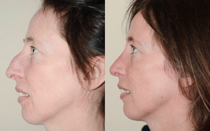 rhinoplasty