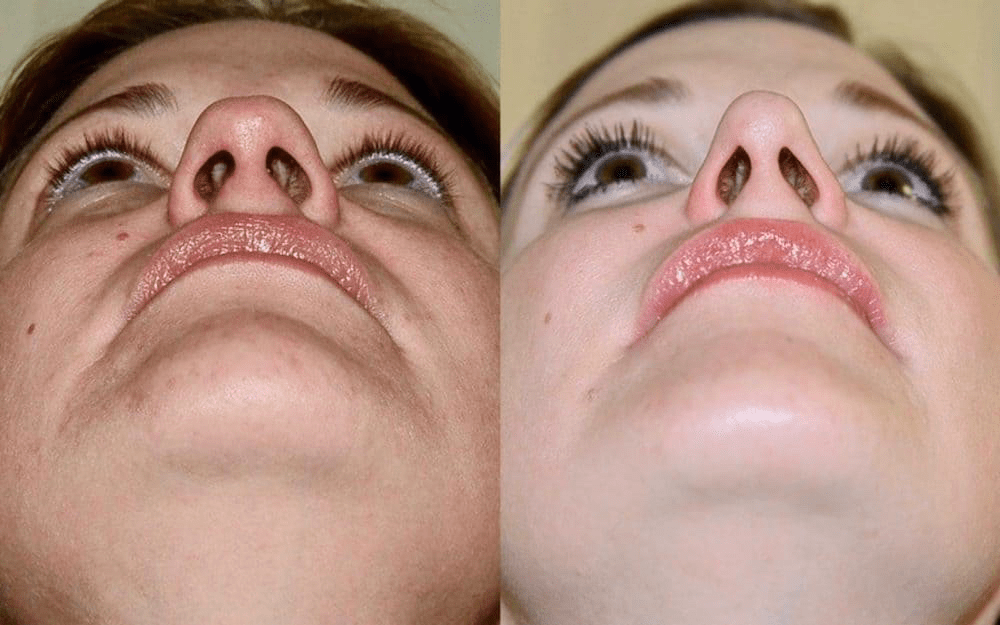 rhinoplasty