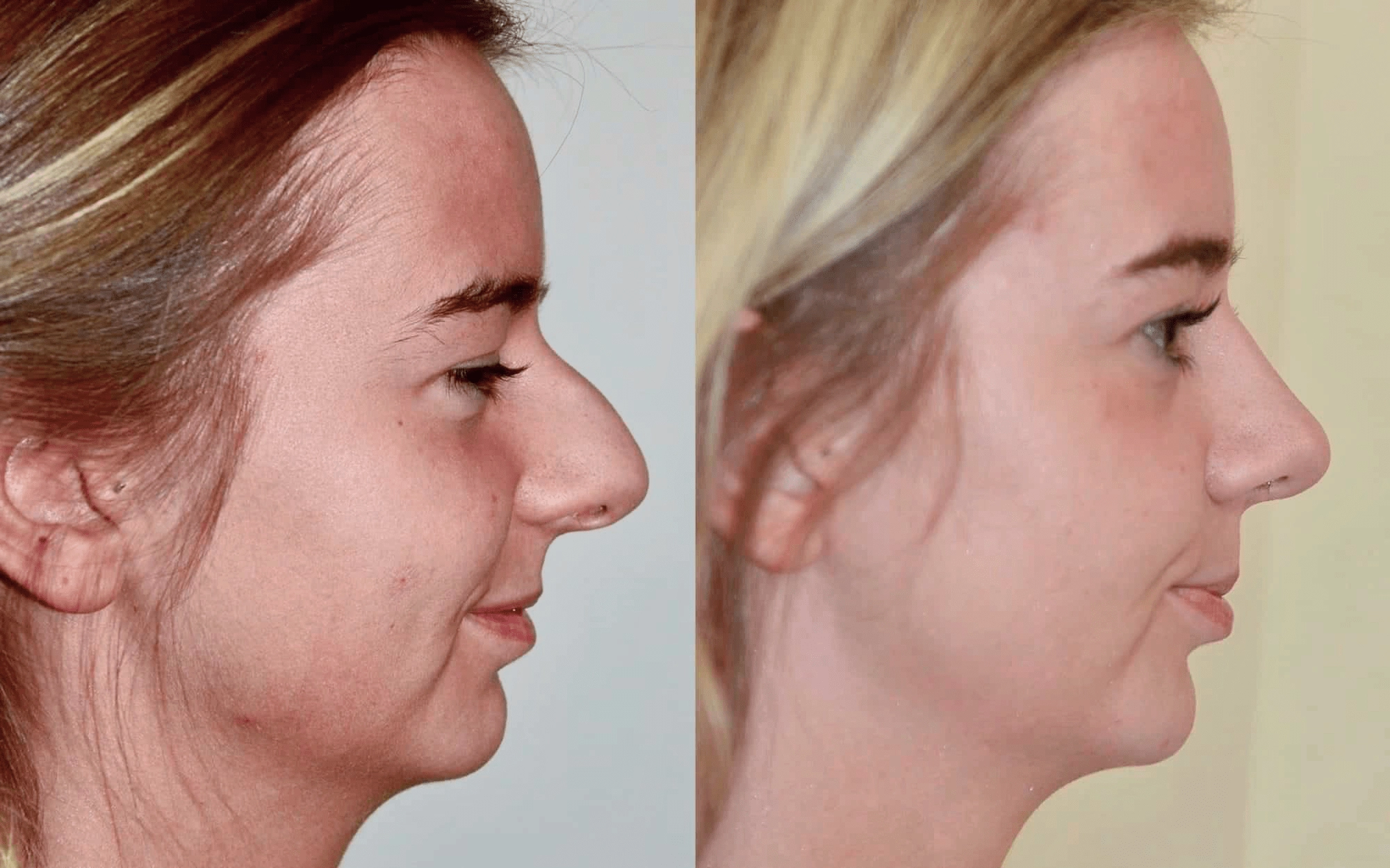 rhinoplasty