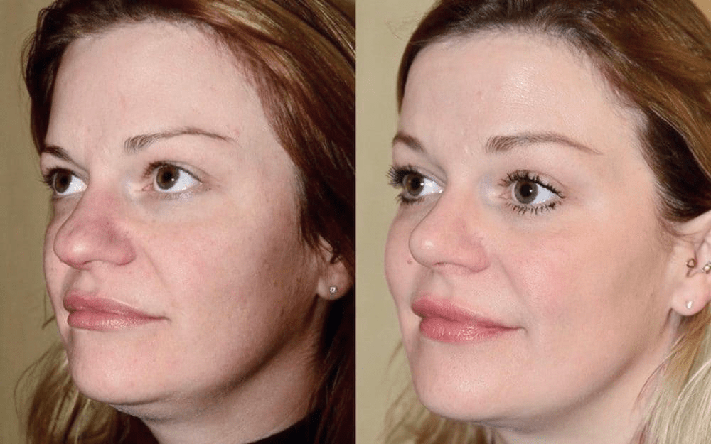 rhinoplasty