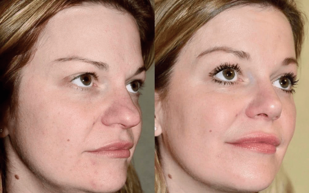 rhinoplasty