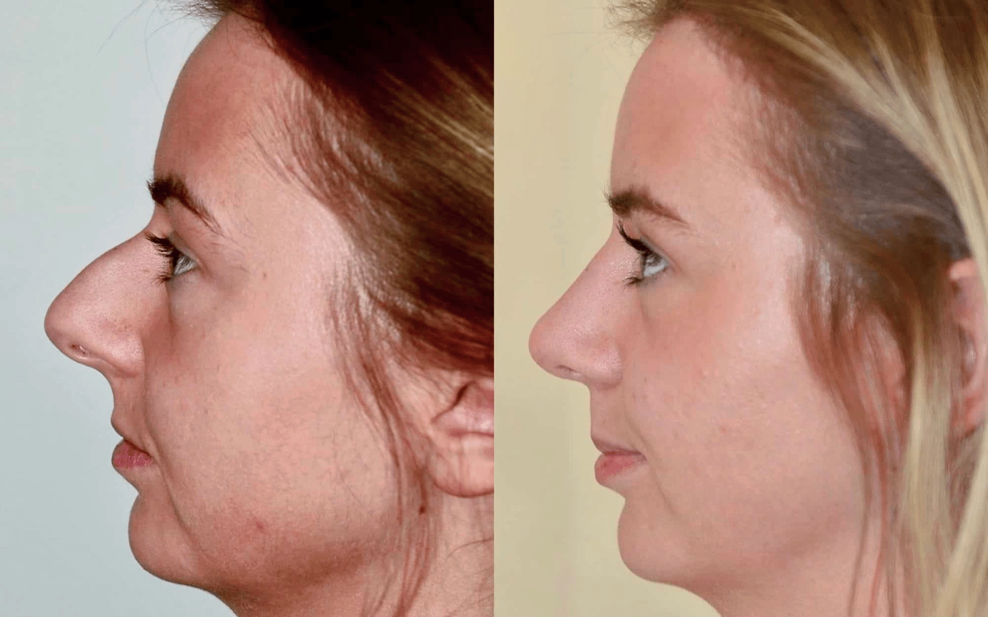 rhinoplasty