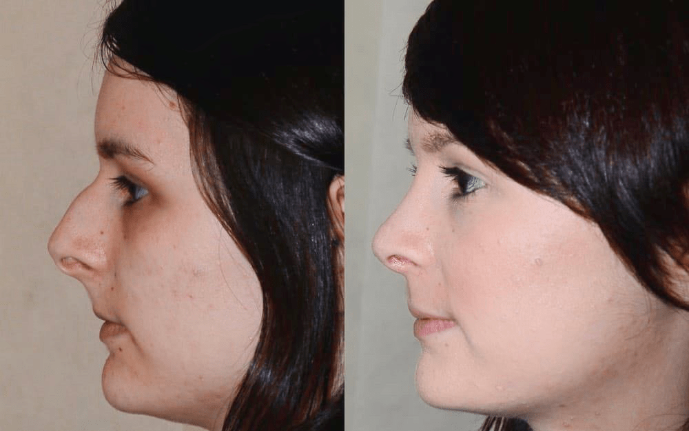 rhinoplasty