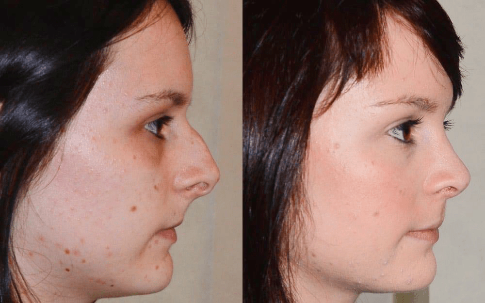 rhinoplasty