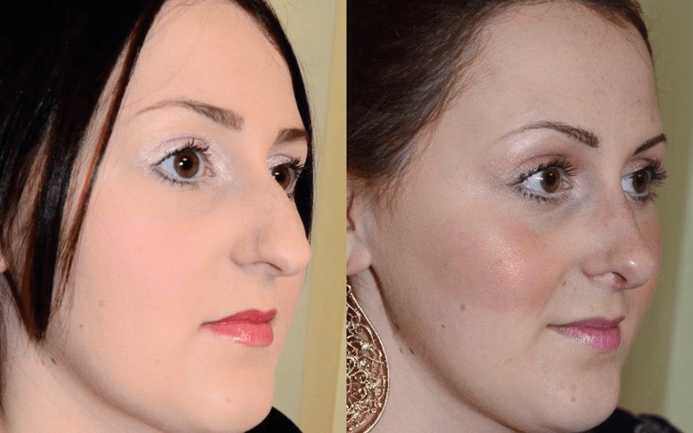 rhinoplasty