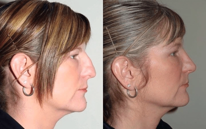 rhinoplasty