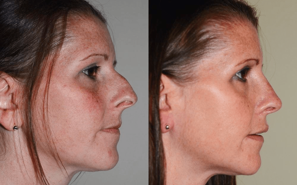 rhinoplasty