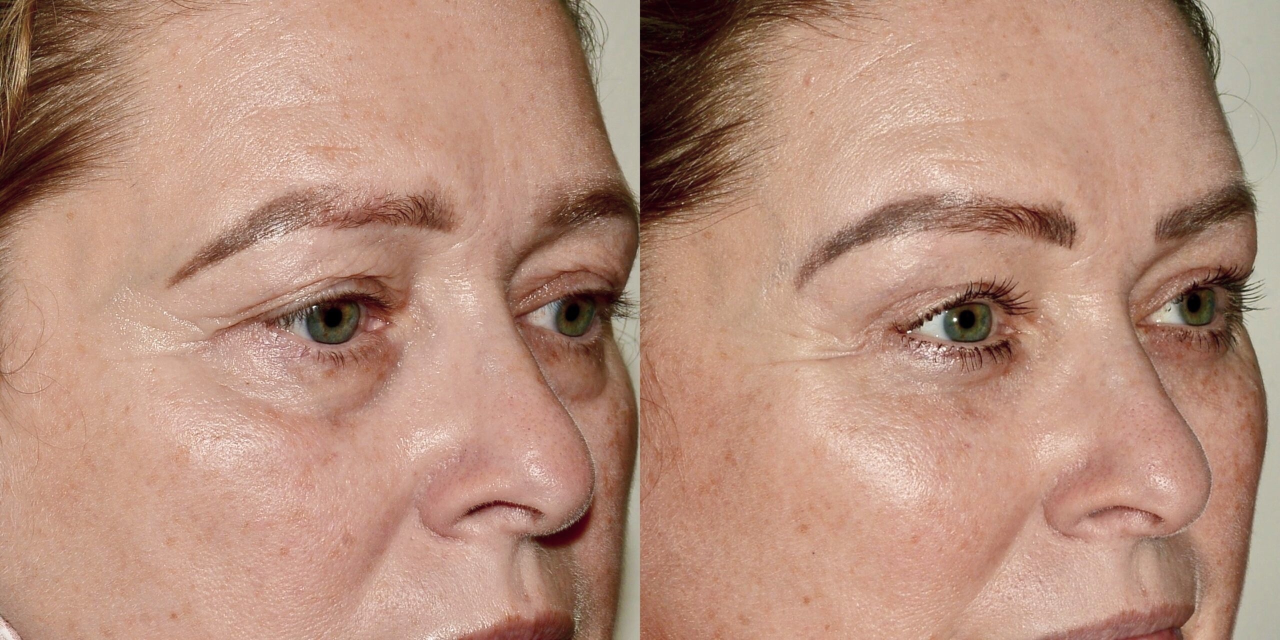 brow lift Scotland