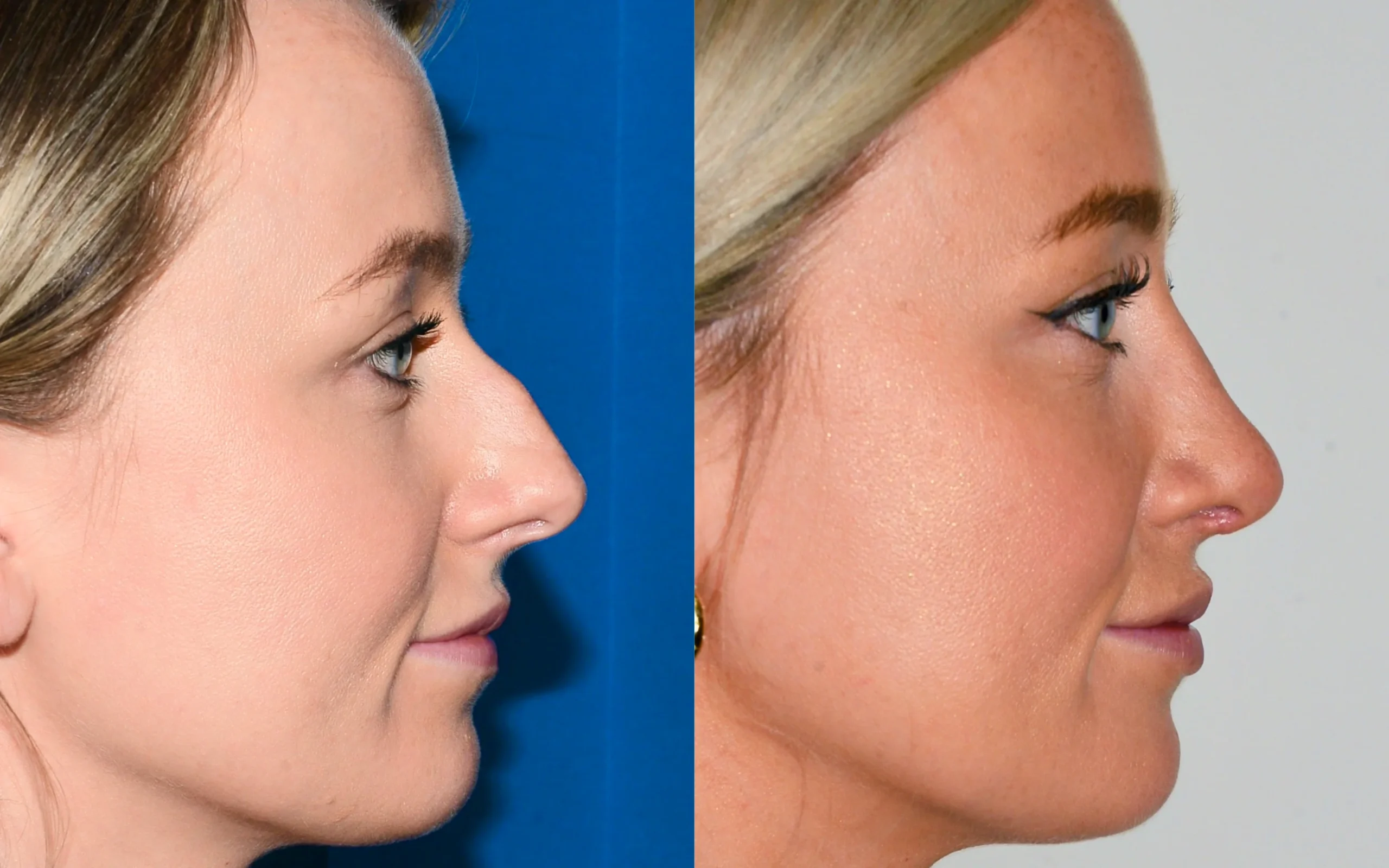 rhinoplasty before after