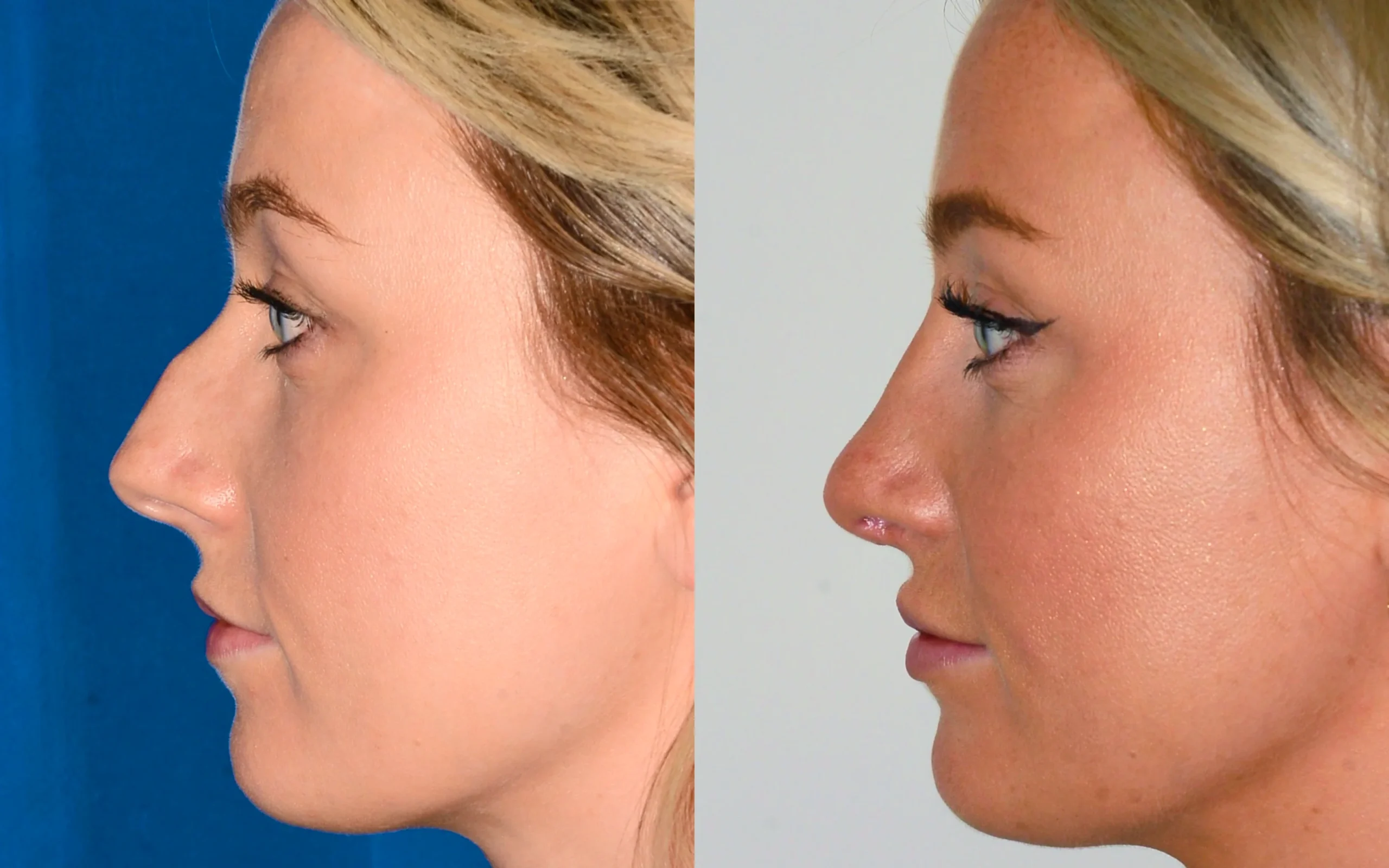 rhinoplasty before after