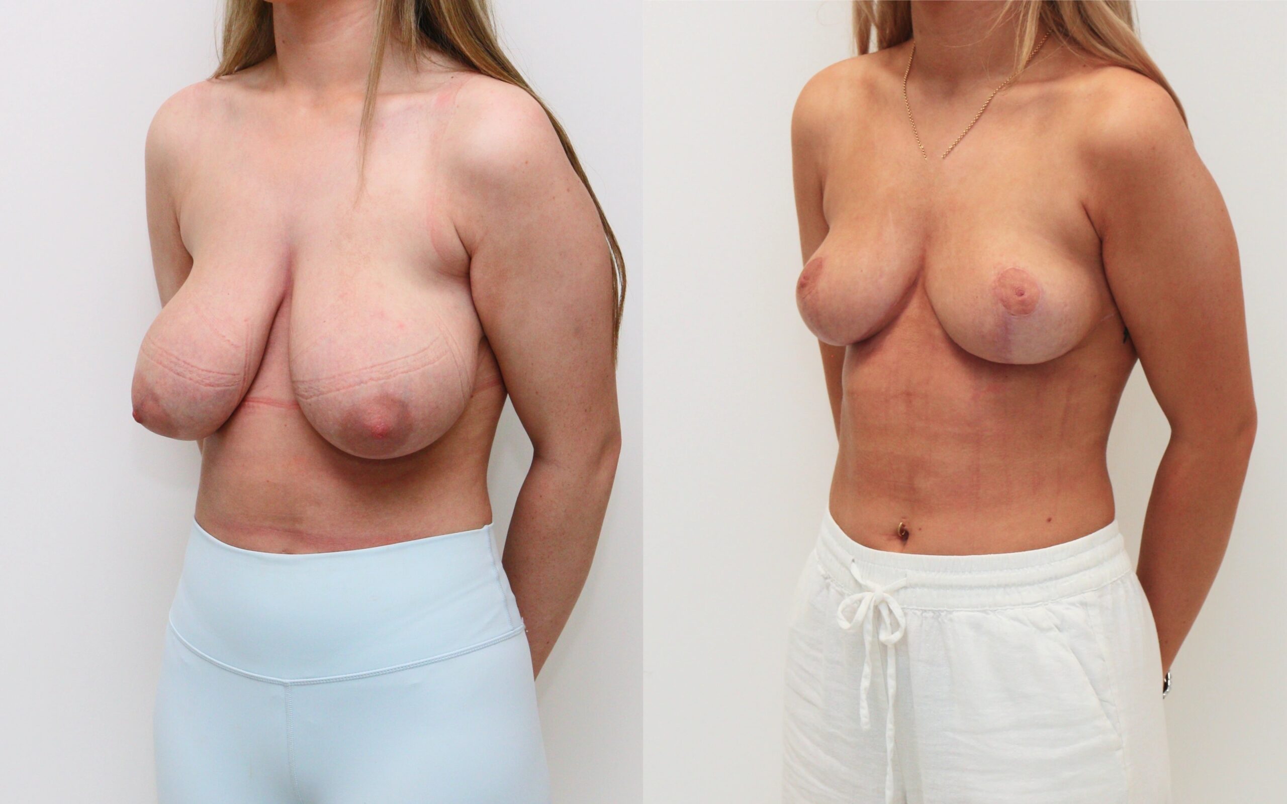 breast uplift