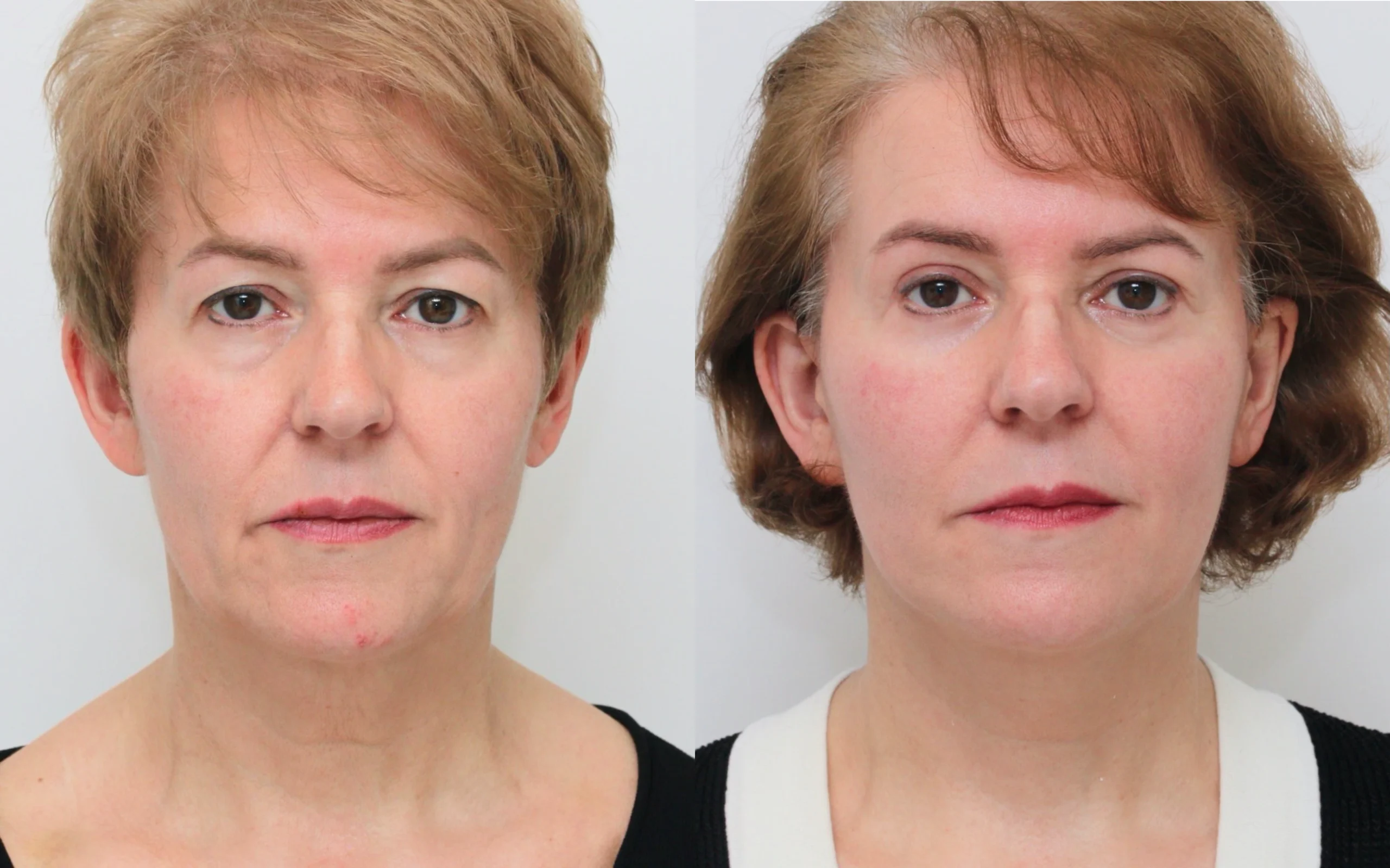 lower face neck lift
