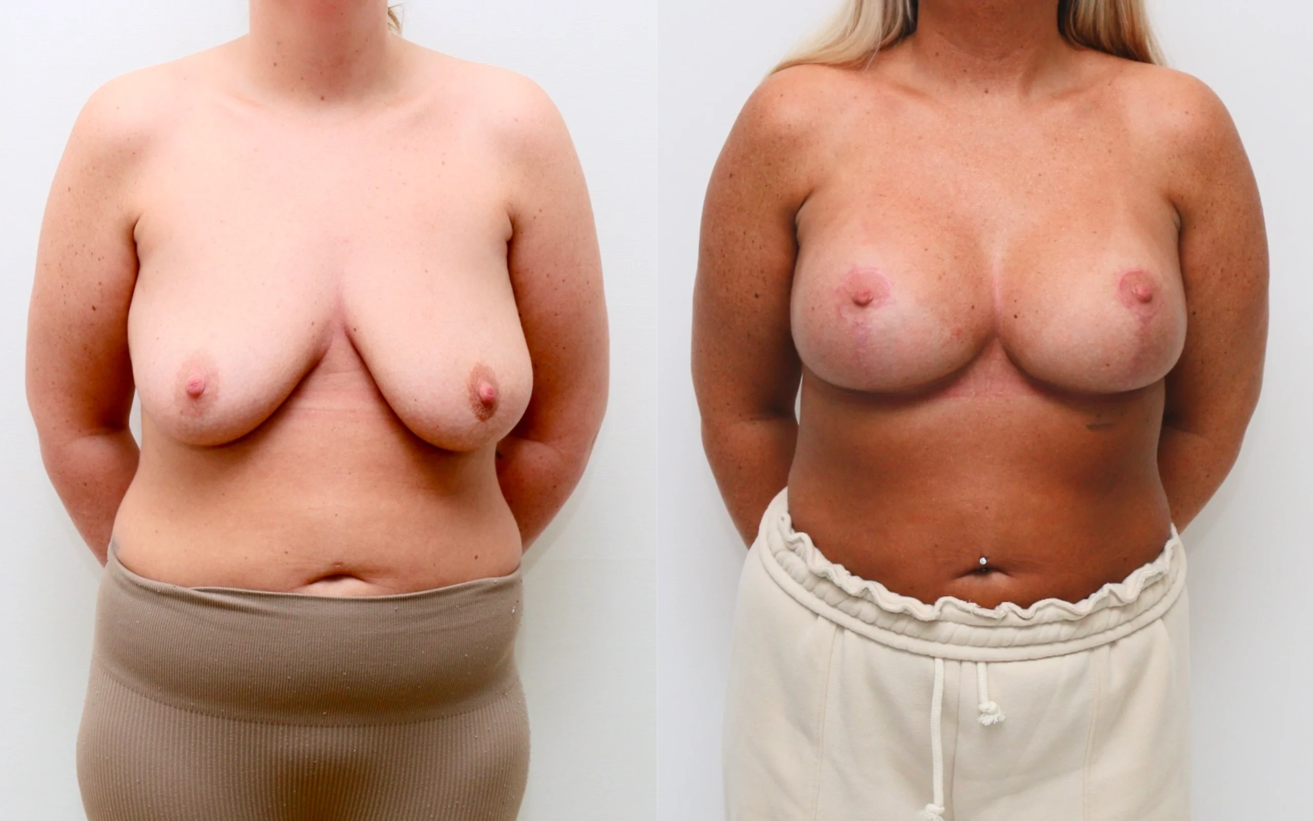 Breast Uplift with Implants