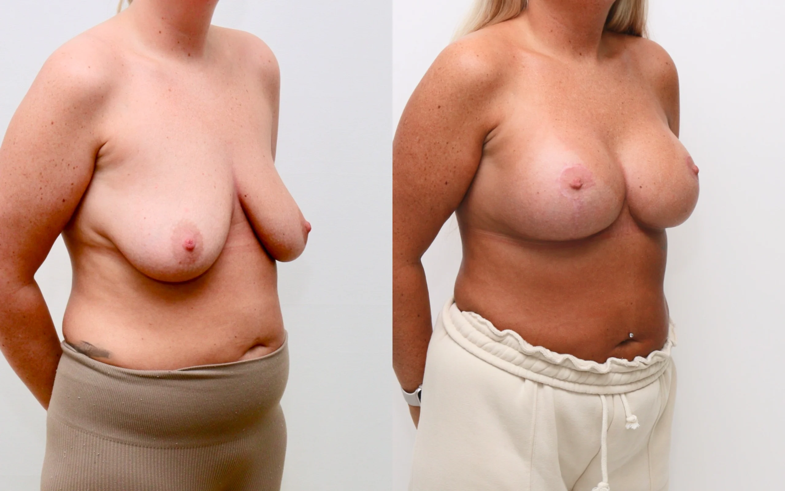 Breast Uplift with Implants