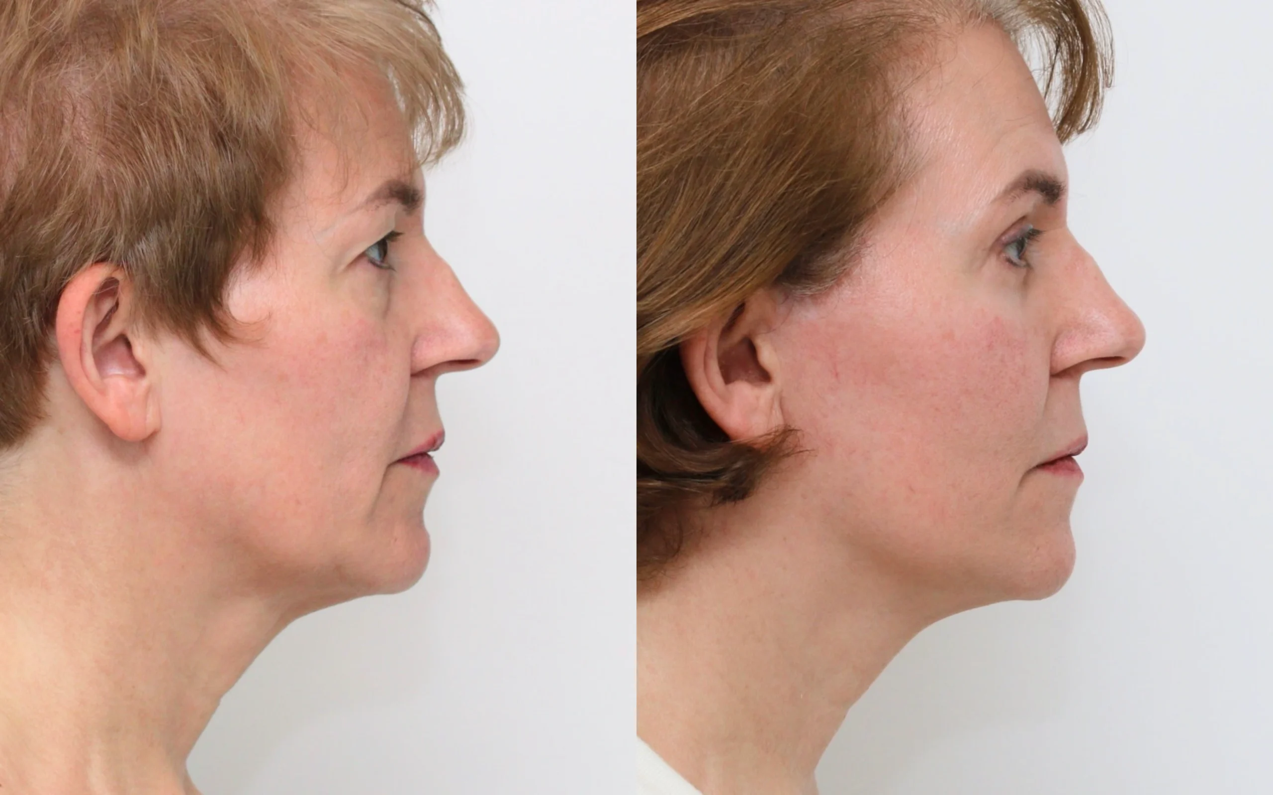lower face neck lift
