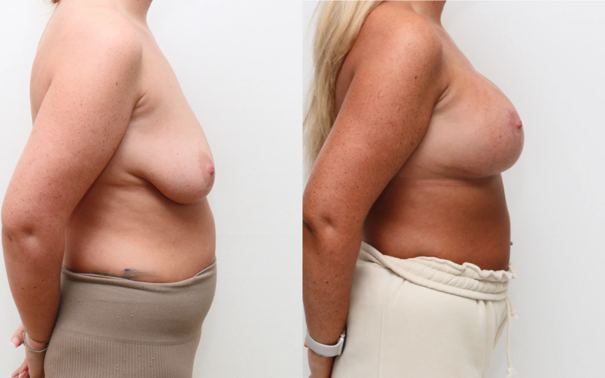 Breast Uplift with Implants