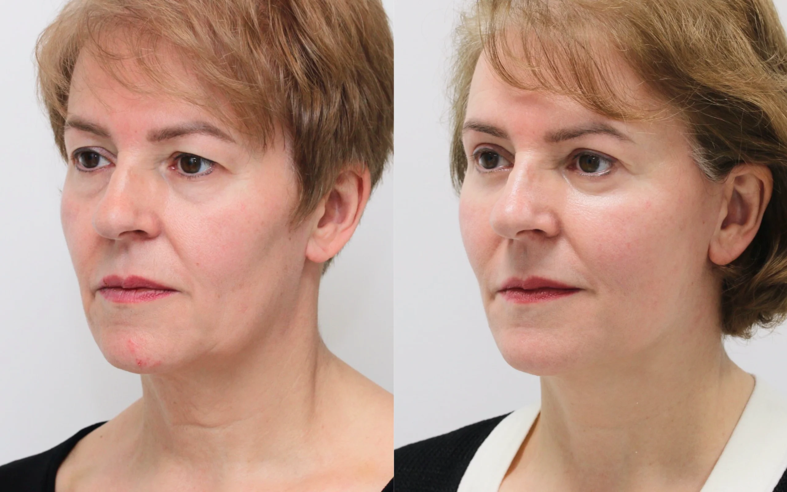 lower face neck lift