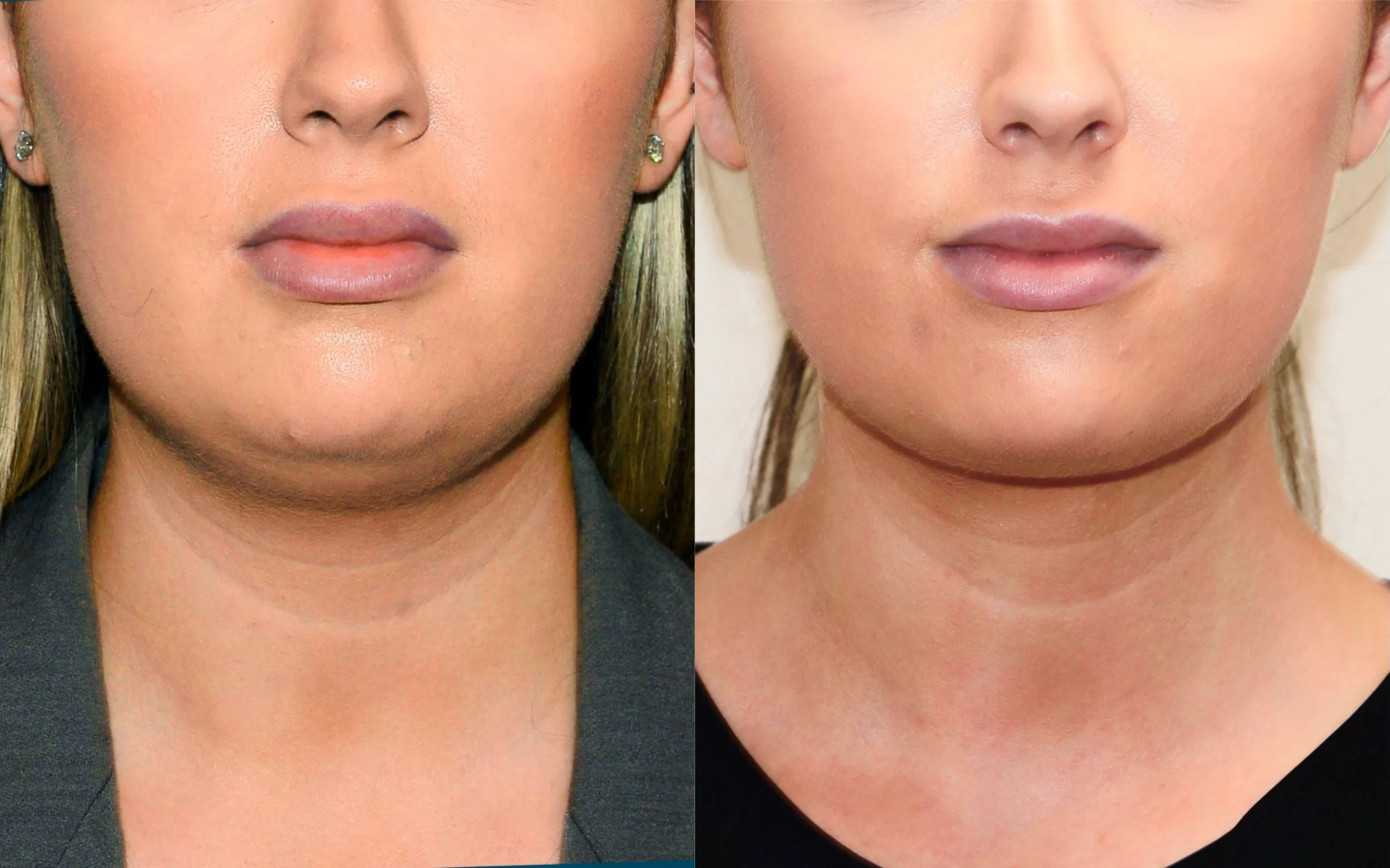Neck liposuction