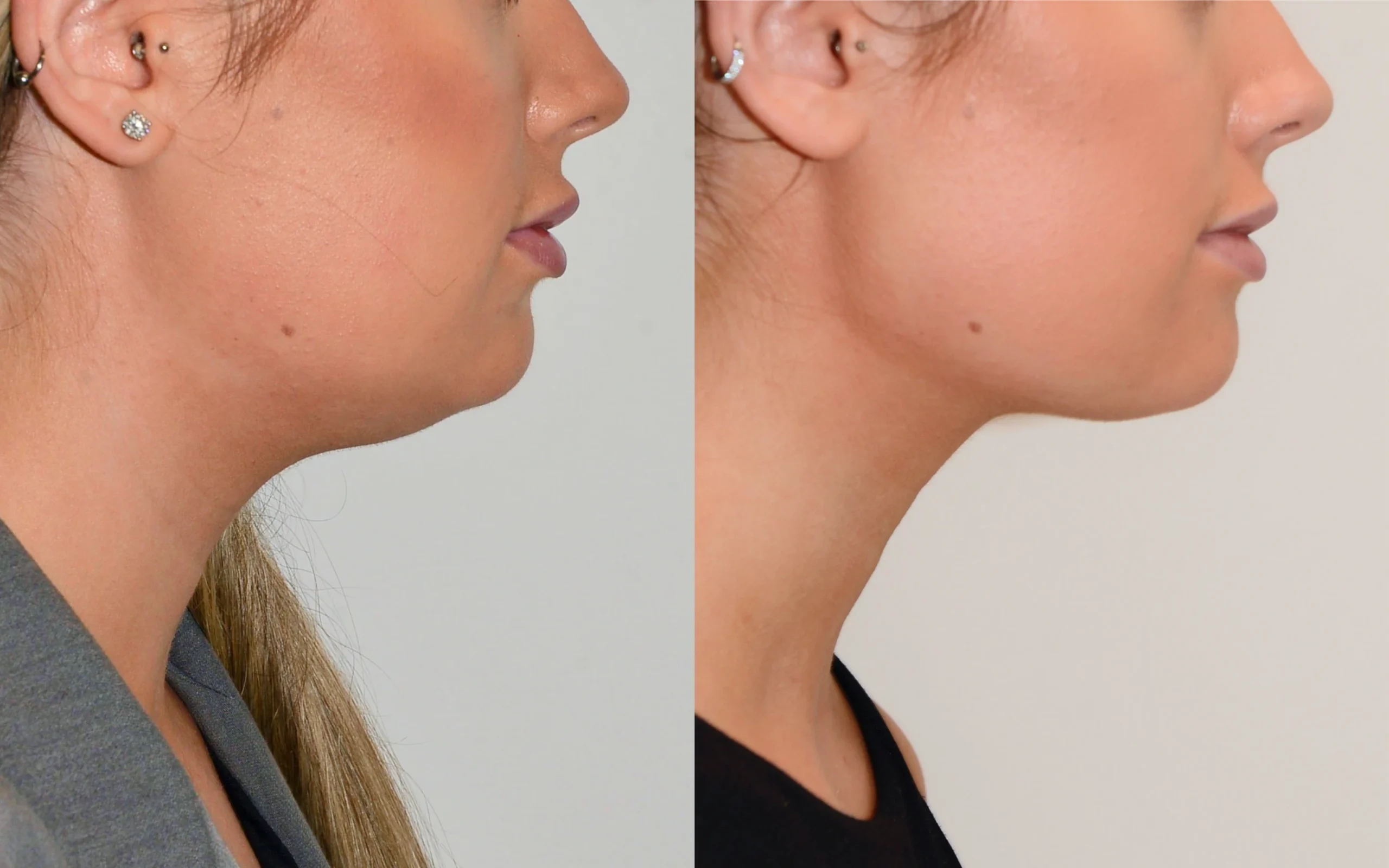 Neck liposuction