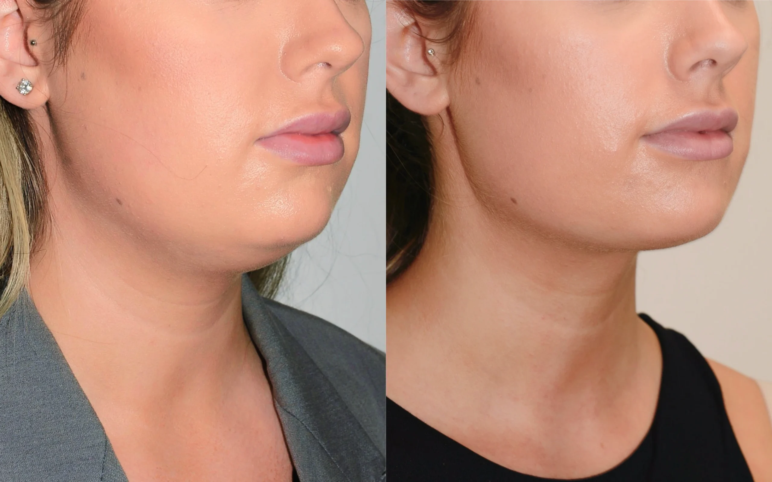 Neck liposuction