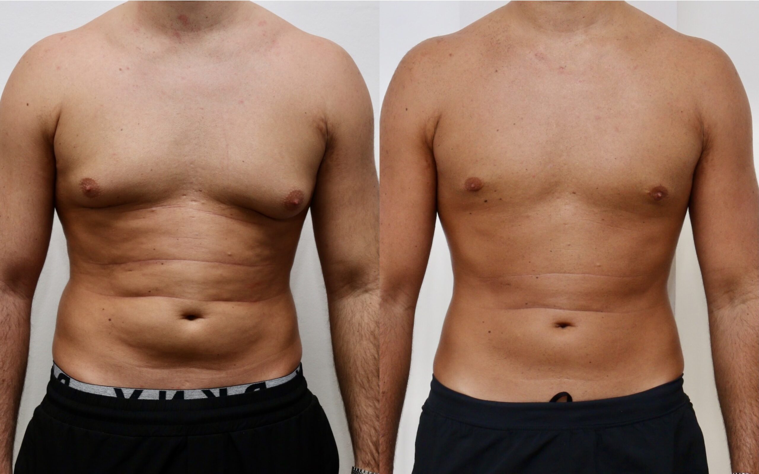 Gynecomastia Surgery Male Breast Reduction Edinburgh Gynecomastia Surgery Male Breast Reduction Edinburgh