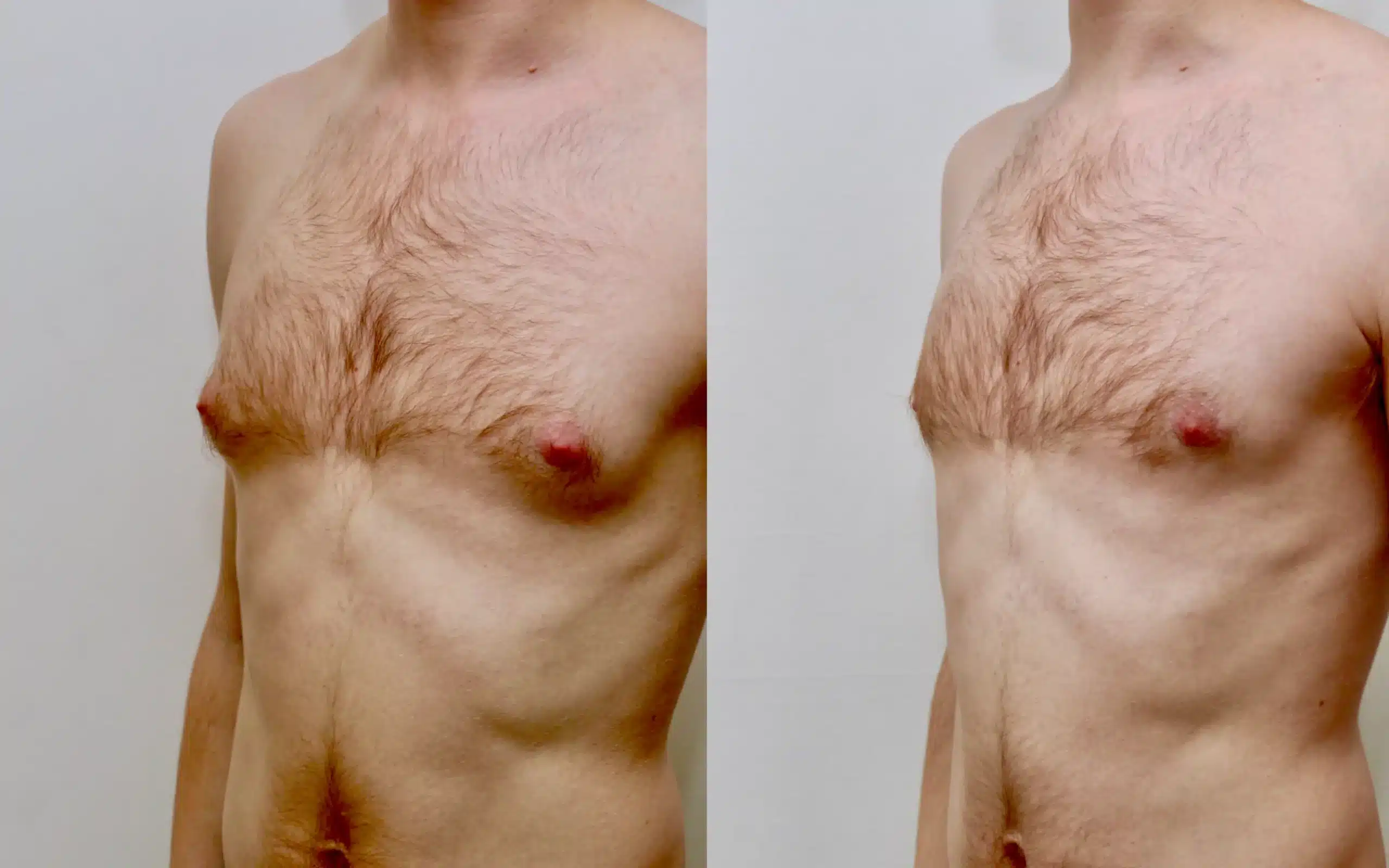 gynecomastia before after