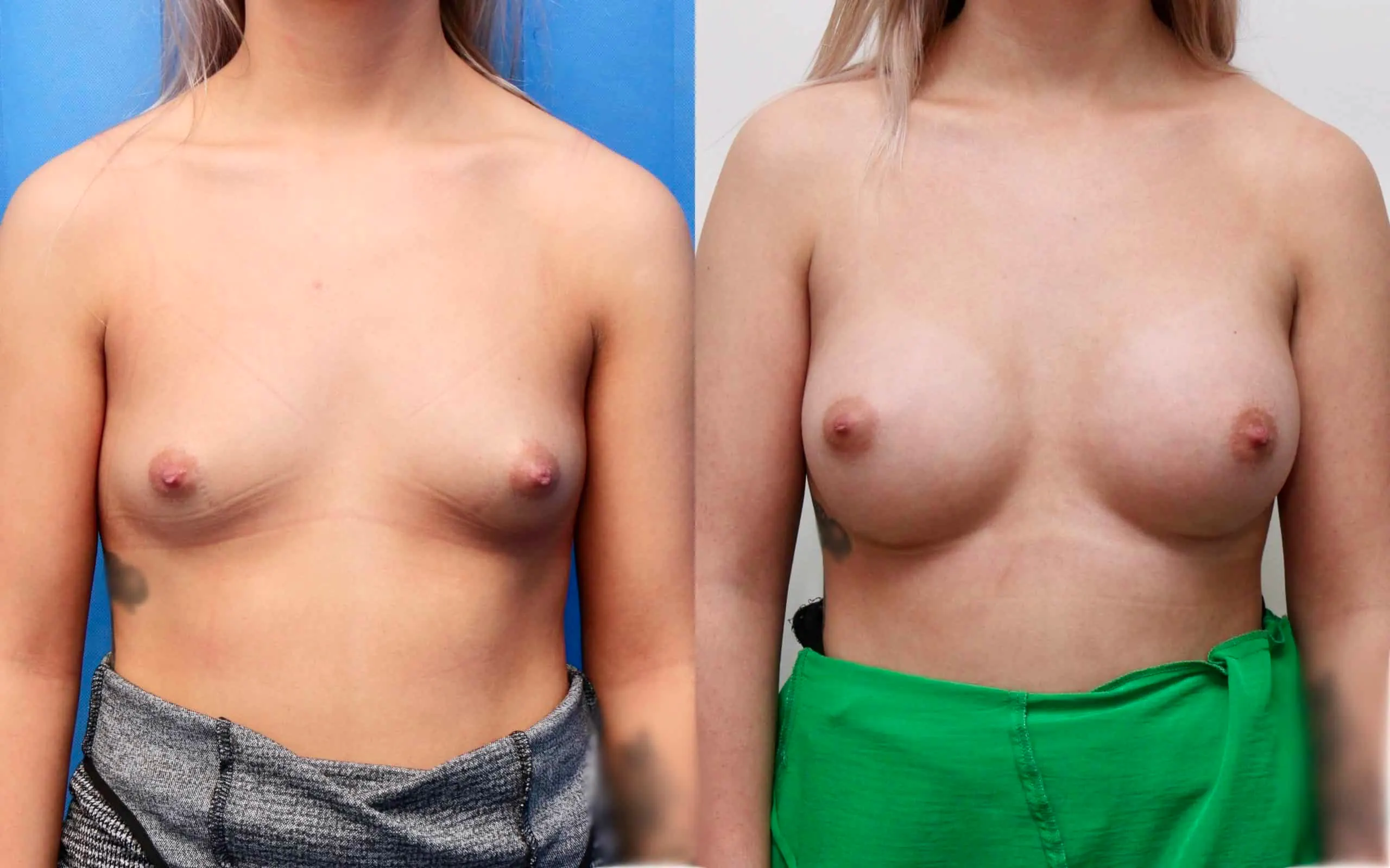 breast implants scotland