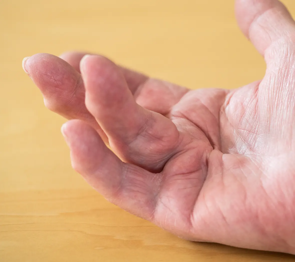 Dupuytren's treatment Edinburgh
