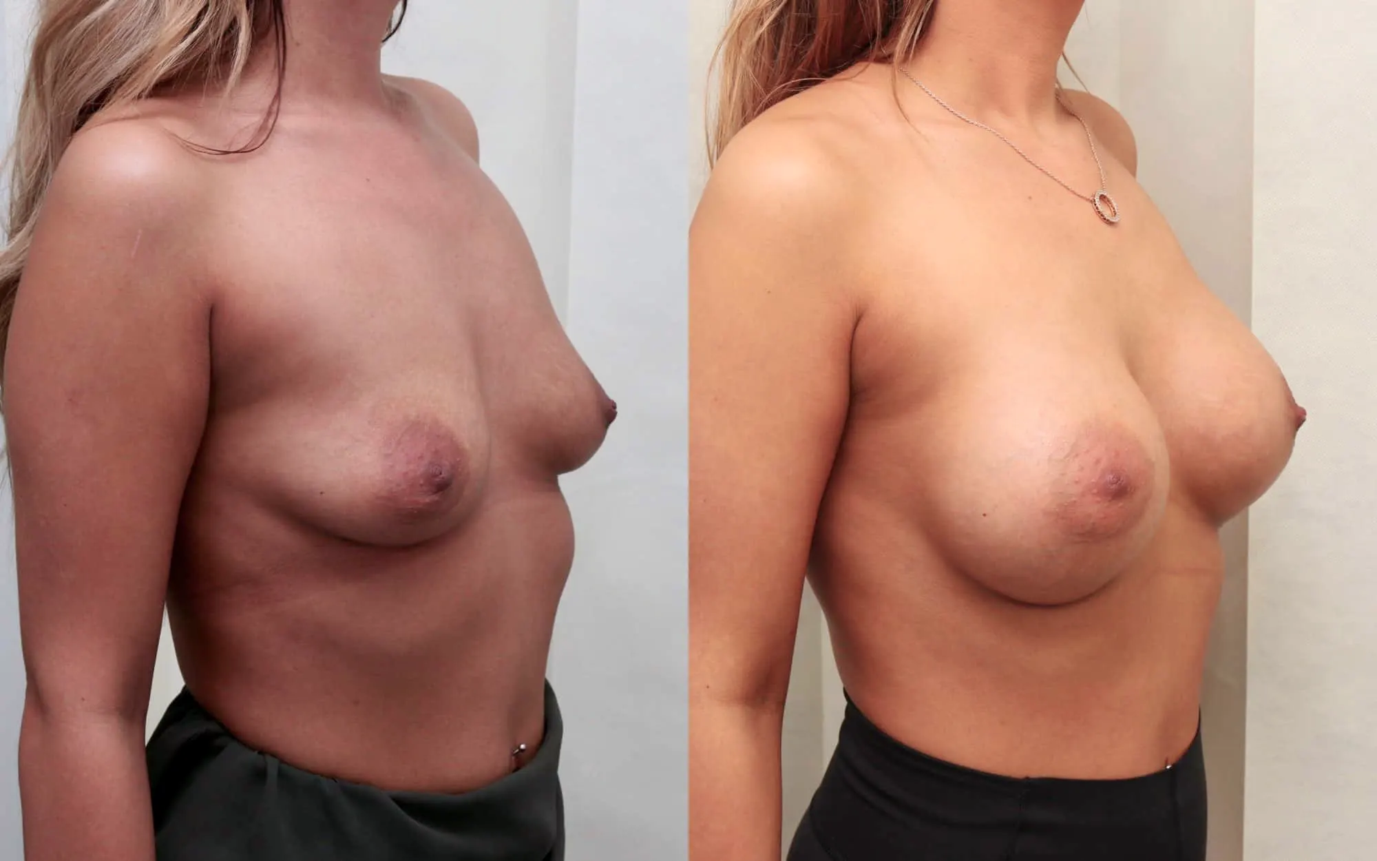 breast implants scotland