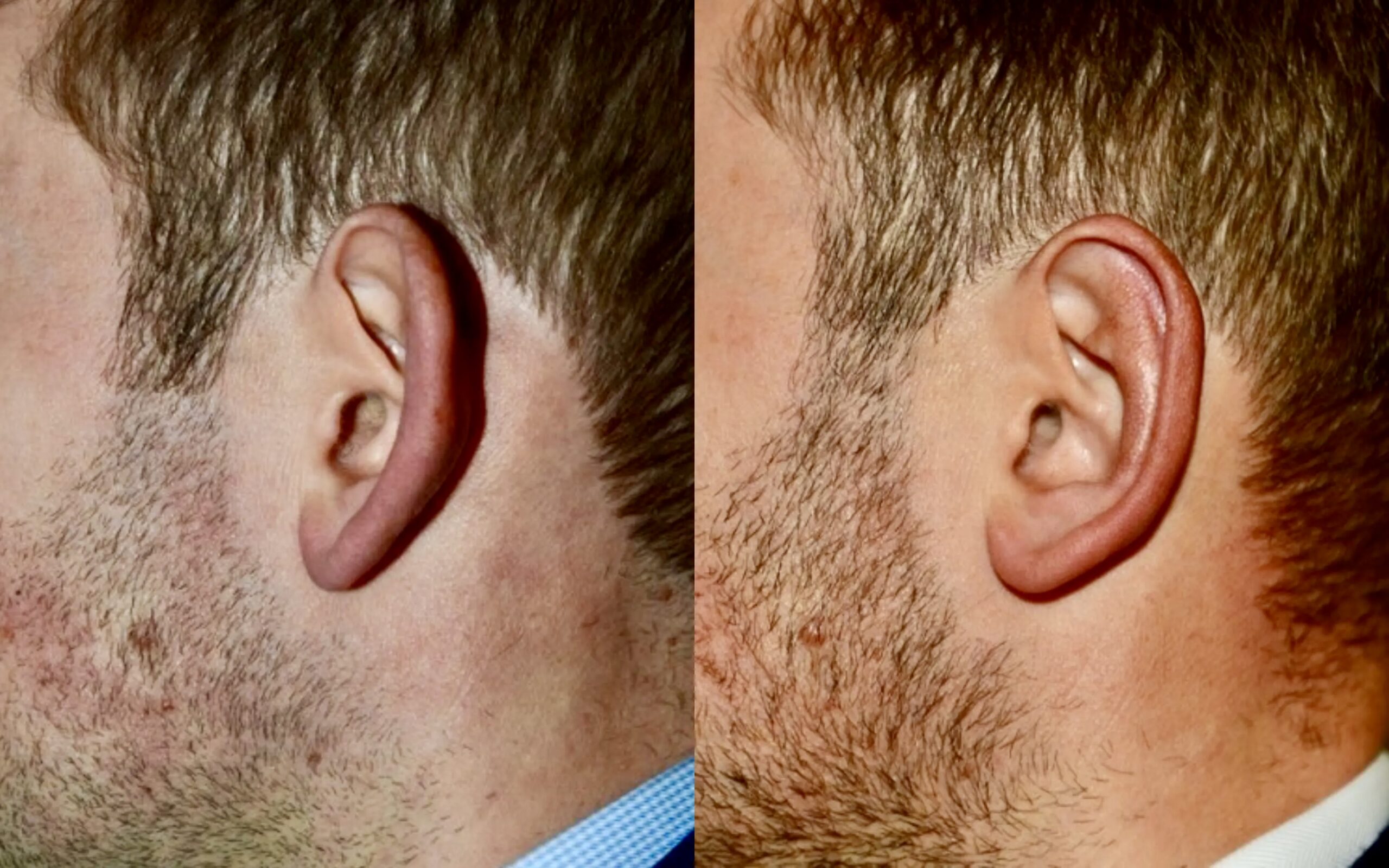 Expert Prominent Ear Correction Edinburgh No.1 Otoplasty Near Me