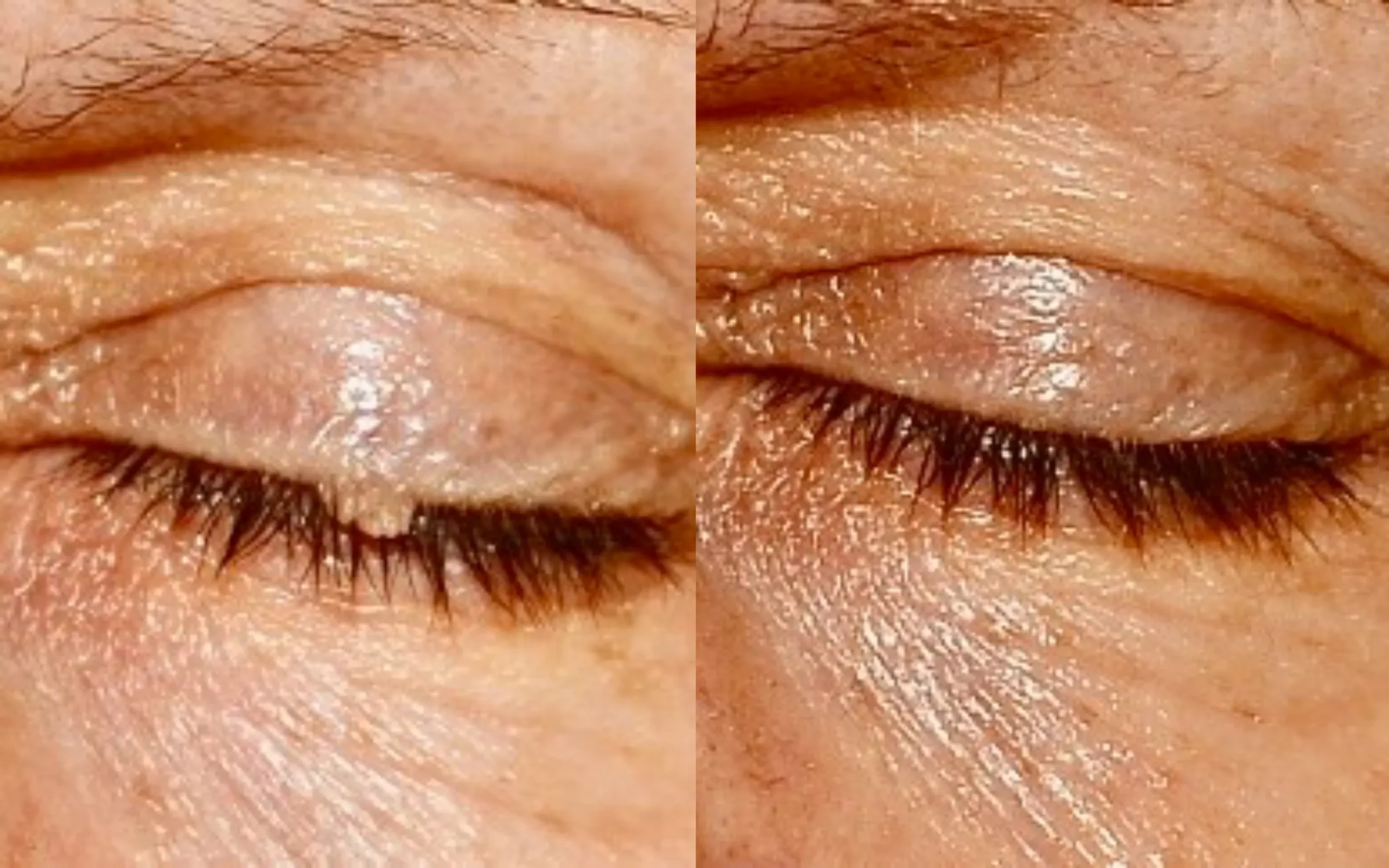Skin tag removal upper eyelid