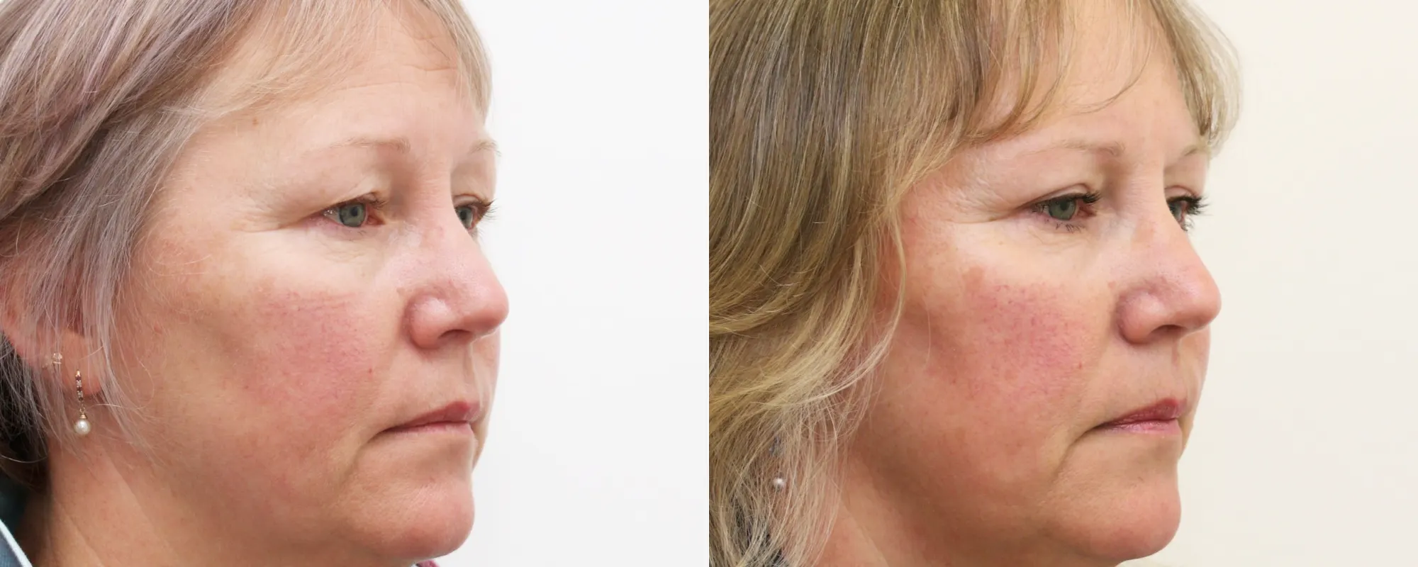 upper eyelids
