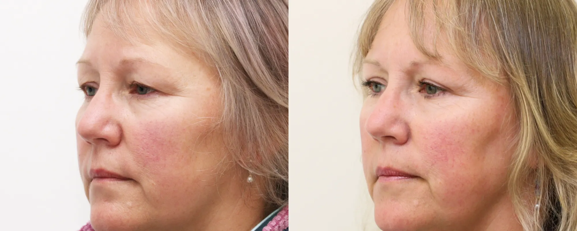 upper eyelids
