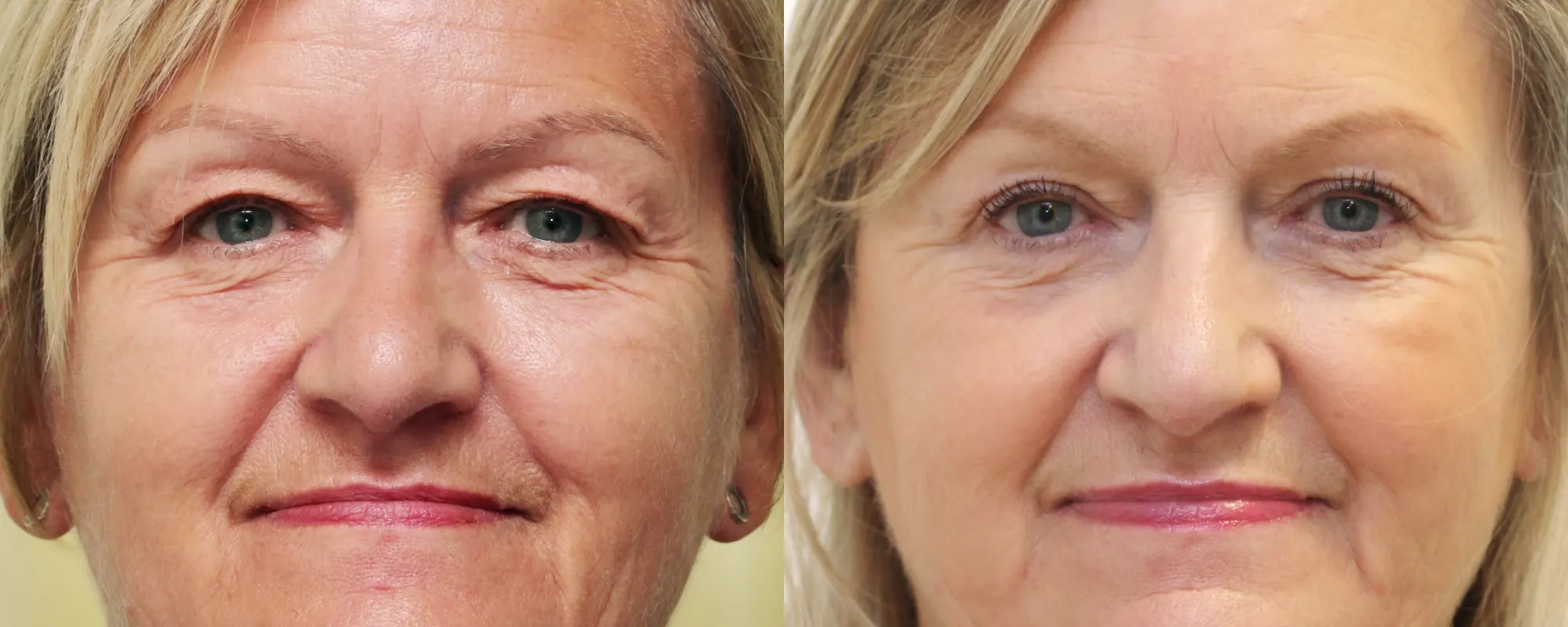 upper eyelids