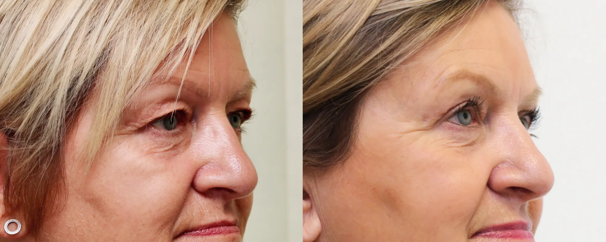 upper eyelids