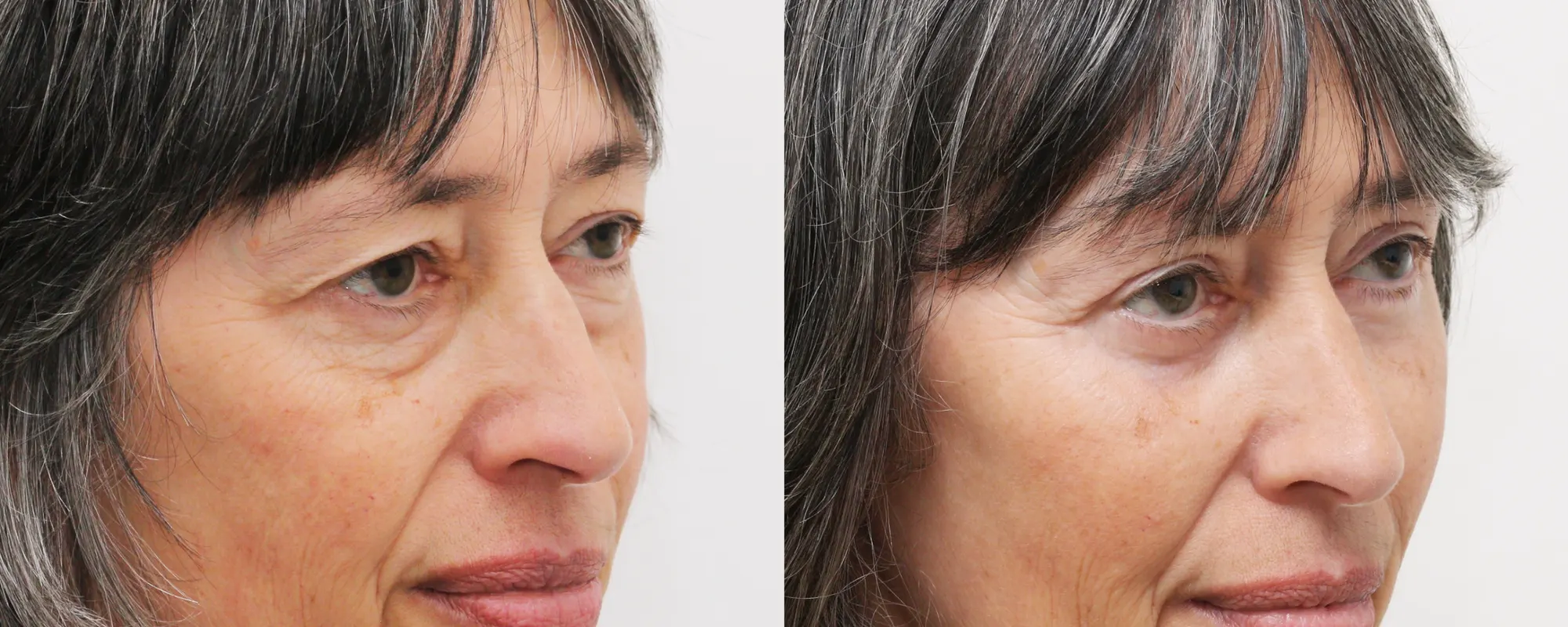upper and lower eyelids