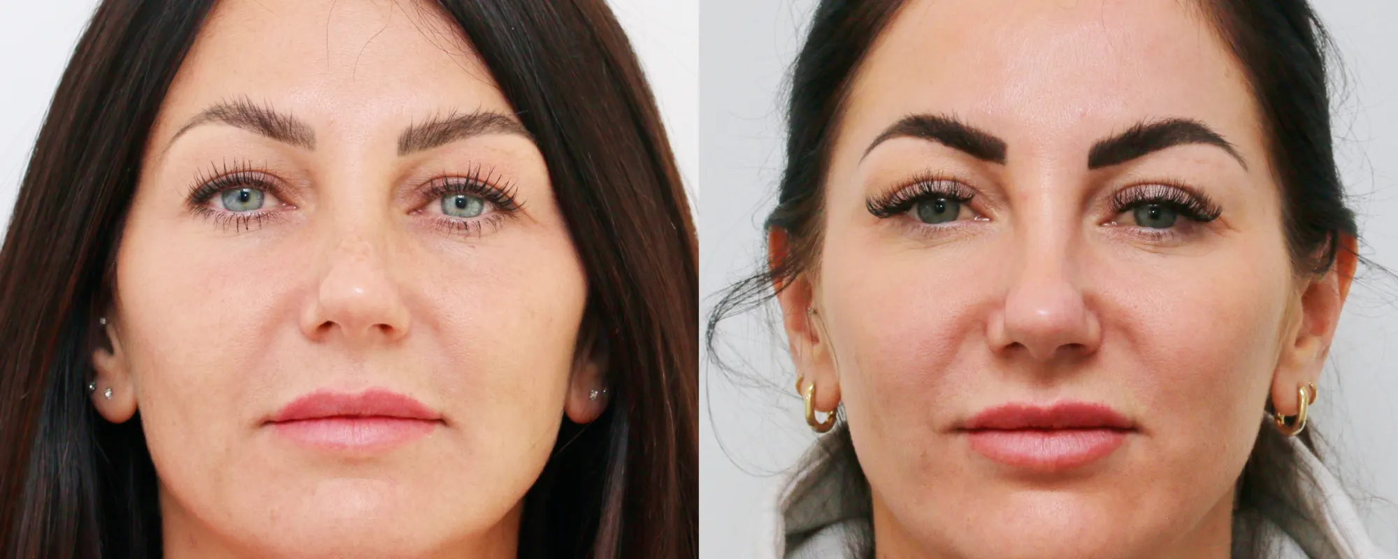 upper eyelids