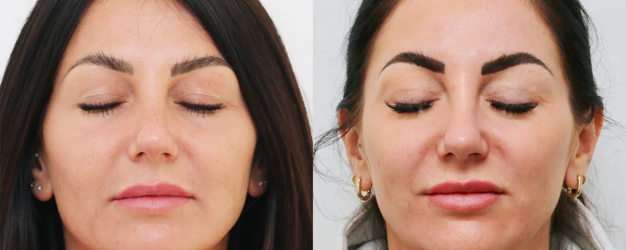 upper eyelids