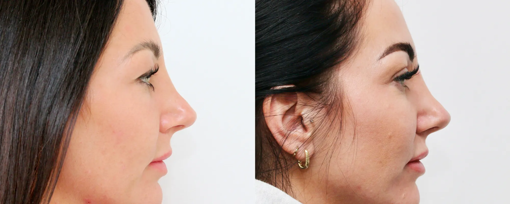 upper eyelids