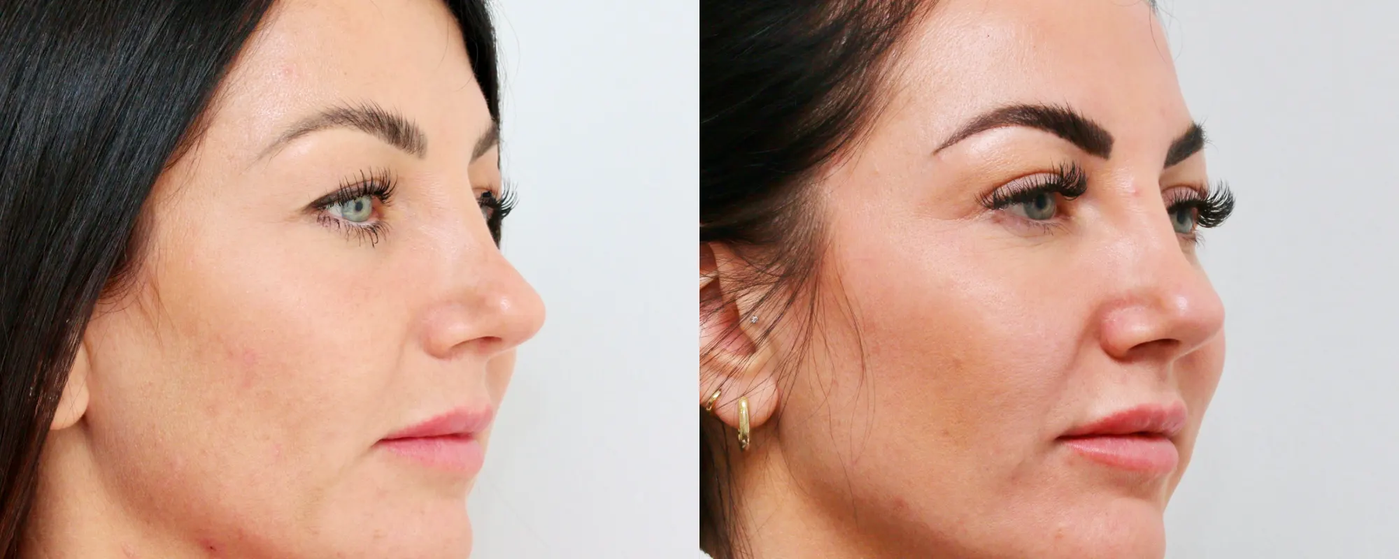 upper eyelids