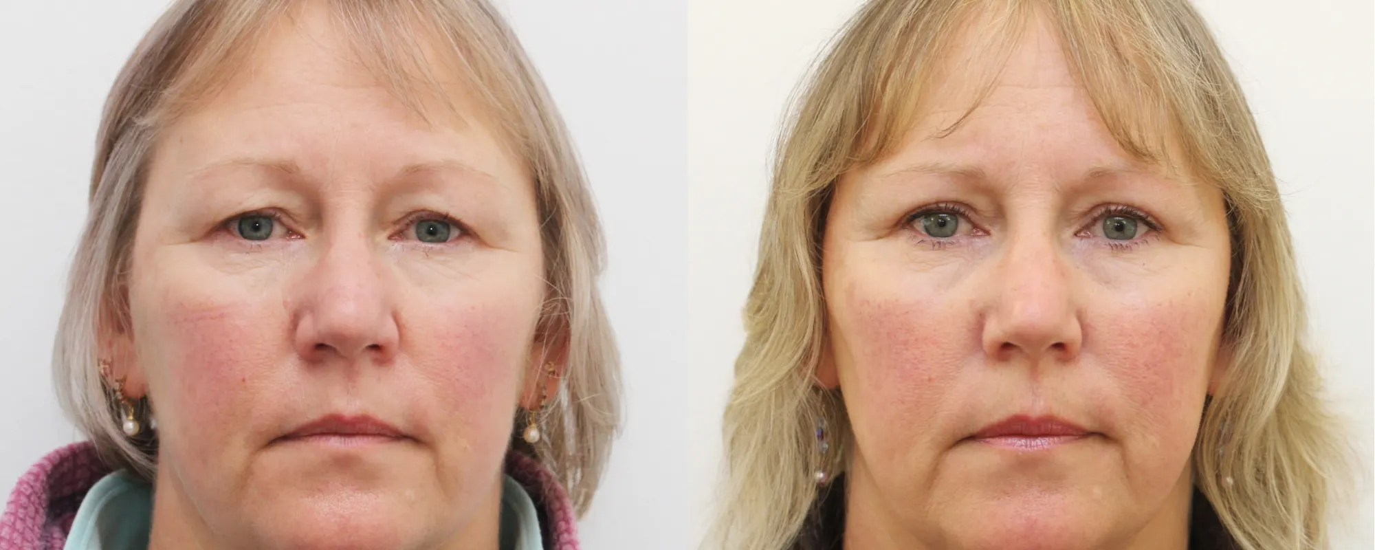 upper eyelids