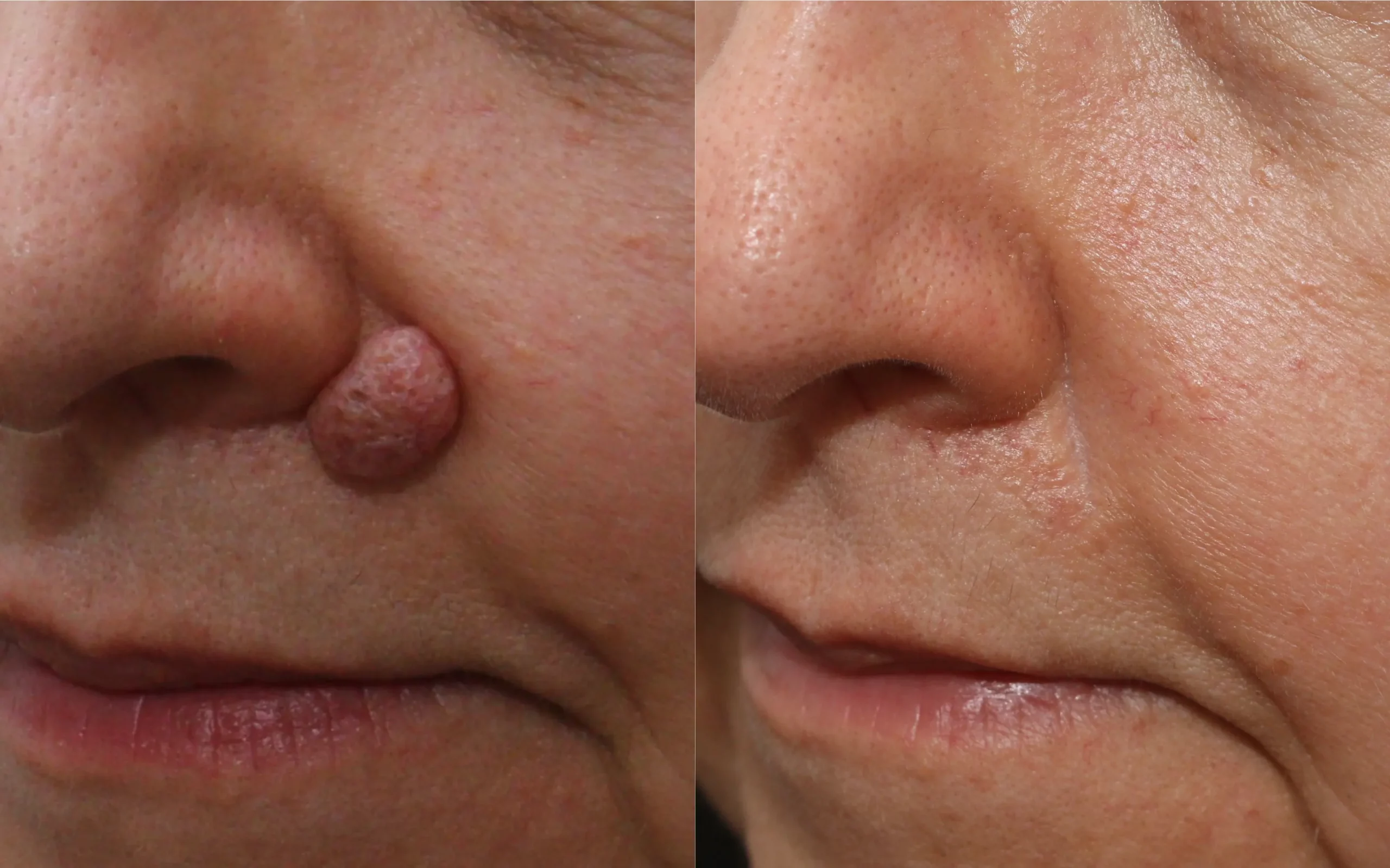 Papilloma removal nose/ cheek