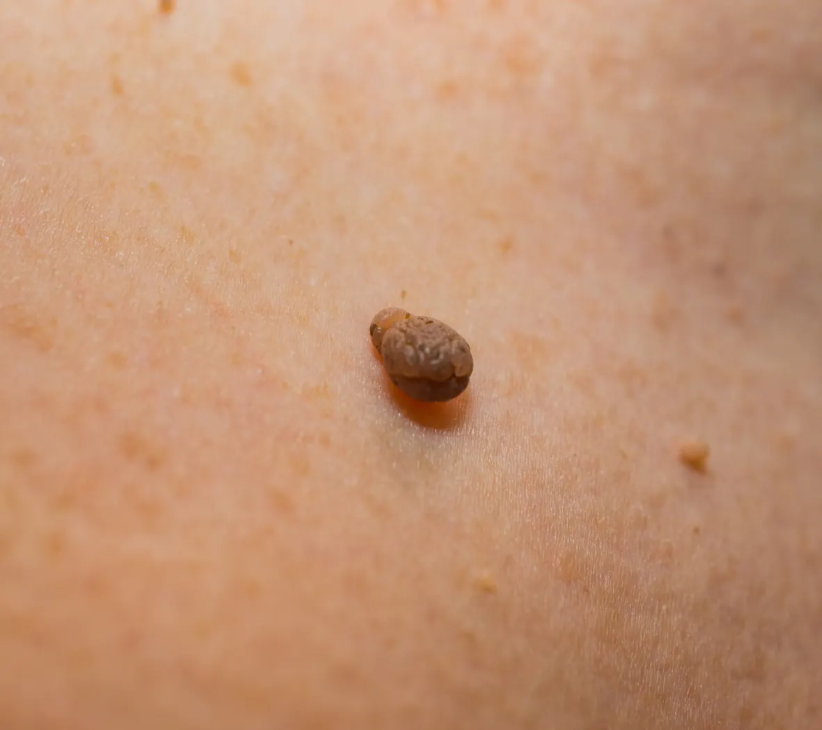 skin tag on back